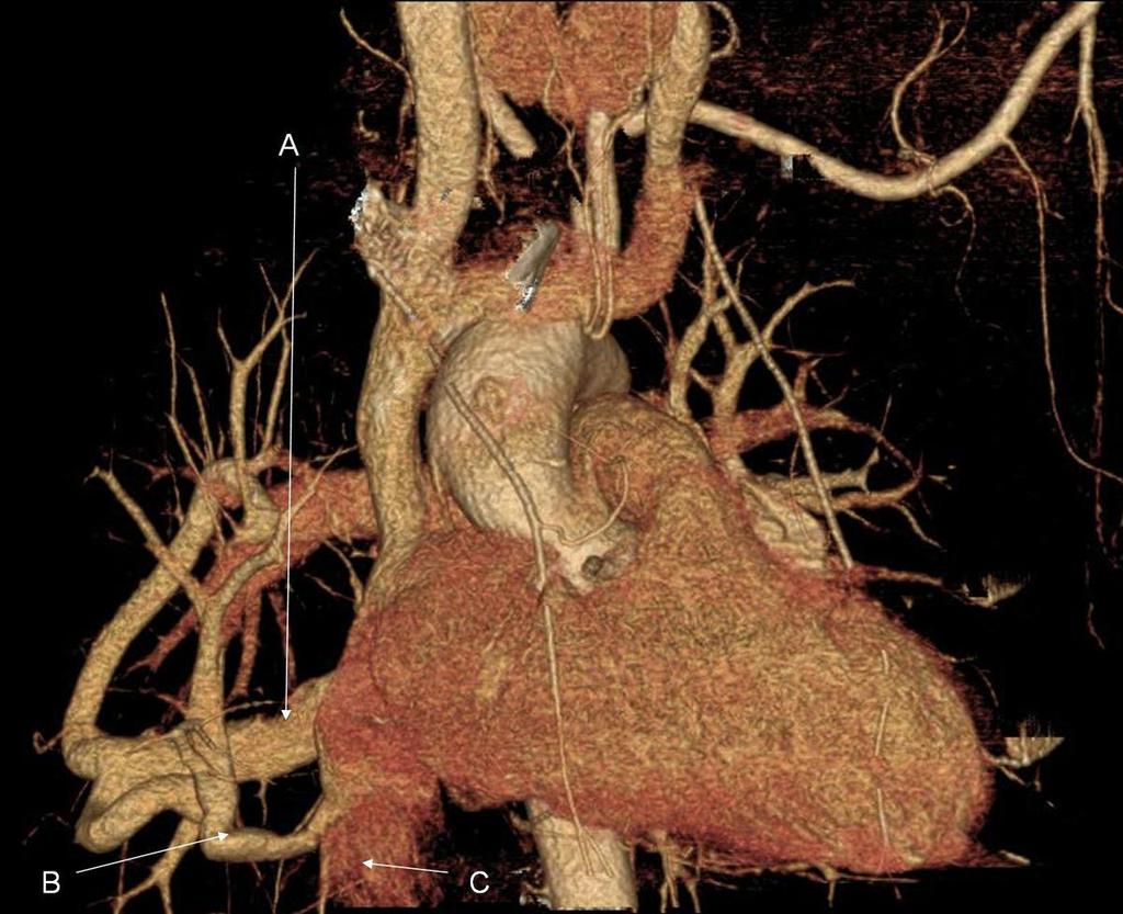 Otros hallazgos que pueden estar presentes son: Arteria pulmonar derecha ausente o de pequeño tamaño. Presencia de vasos arteriales desde la aorta al pulmón hipoplásico. Secuestro pulmonar.