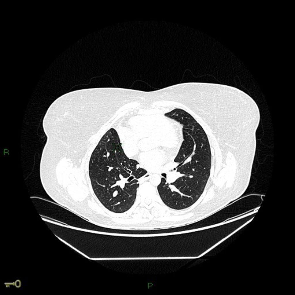 Fig. 6: Imagen axial de TCMD que pertenece al paciente de la figura anterior que muestra hipoplasia del pulmón derecho. 3.