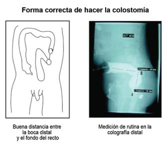 Malformaciones anorectales en niños / Ceciliano-Romero N et al Referencias Figura 3.