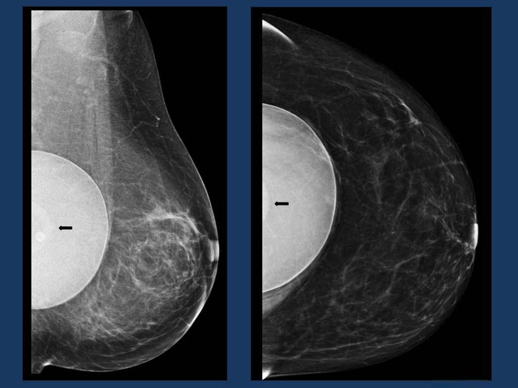 Fig. 3: RM mamaria. Prótesis mamaria de silicona.