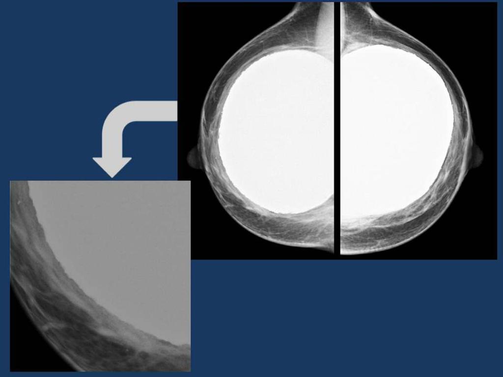 Fig. 14: Contractura capsular de prótesis mamaria izquierda. Mamografía: prótesis mamaria retropectoral de silicona bilateral.