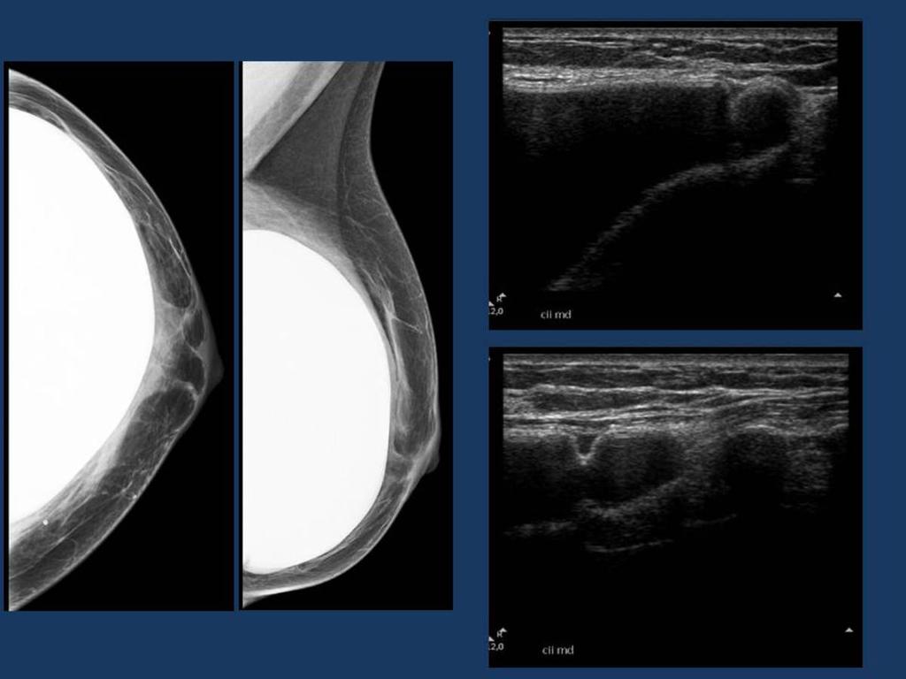 Fig. 17: Mamoplastia de aumento con prótesis mamaria retropectoral de silicona. Mamografía: Se observan pliegues en la superficie de la prótesis mamaria izquierda, compatible con rotura intracapsular.