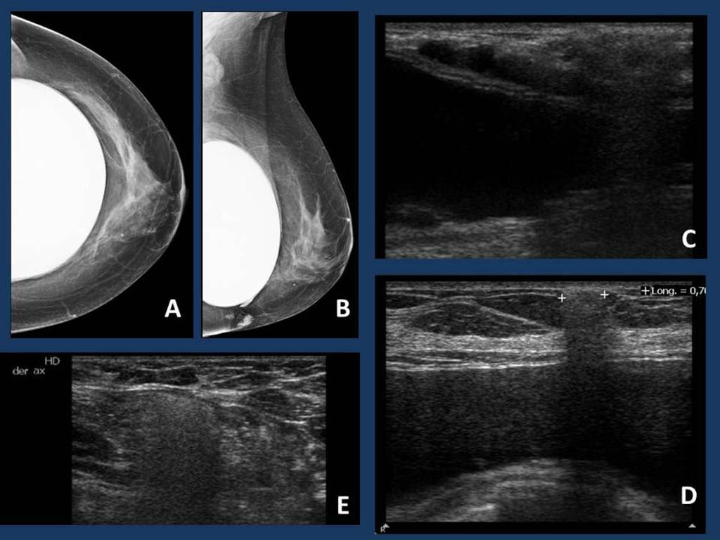Fig. 20: Prótesis de silicona retroglandular en mama derecha. Mamografía: prótesis de morfología redondeada, con calcificaciones periprótesicas y una lobulación en el margen interno.