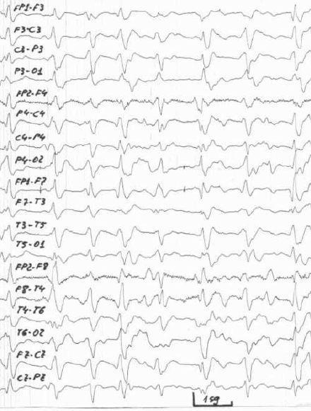 Pruebas diagnósticas: EEG Complejos de ondas bi o tri fásicas que se repiten de forma periódica con frecuencia de 0.