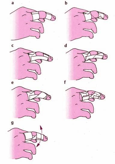 16 a y b Vendaje funcional de dedo