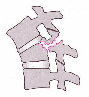 Los síntomas principales son los dolores crónicos de espalda (y dolor lumbar con un fuerte estiramiento de la musculatura de la espalda, sobreestirada y acortada, así como el acortamiento del músculo