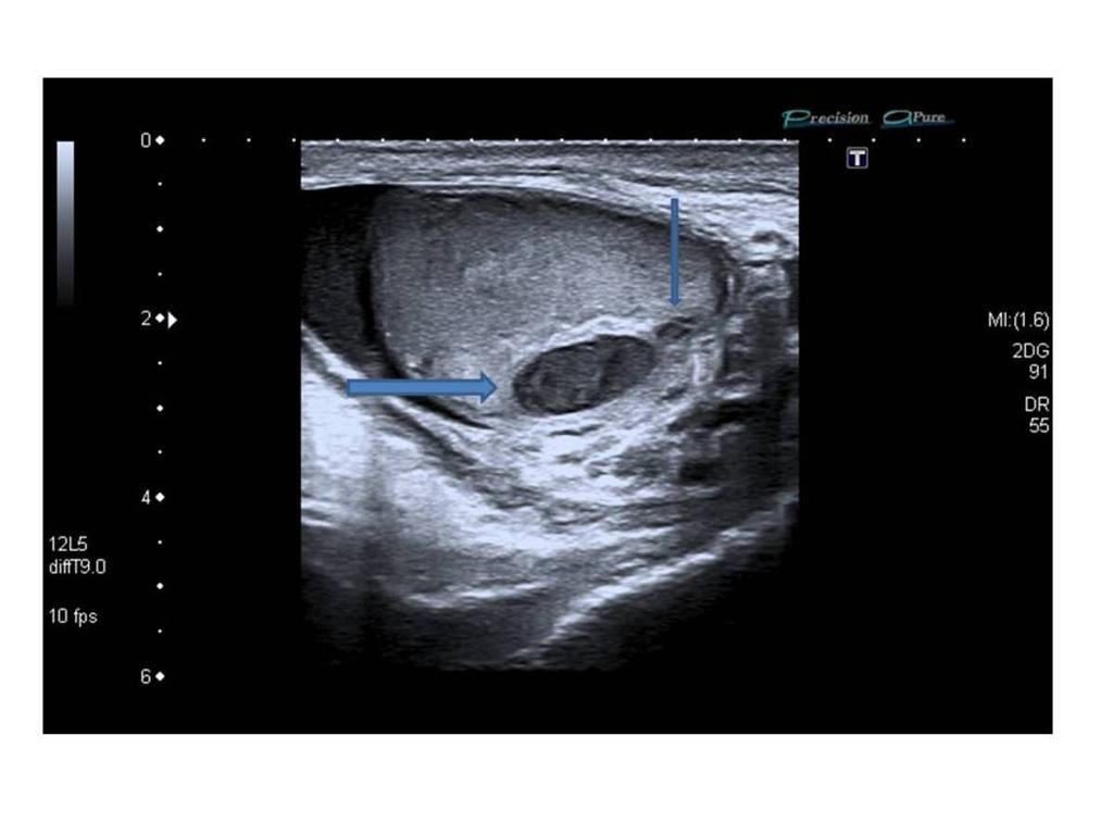 Fig. 10: Absceso testicular. Varón de 67 años con aumento de tamaño del testículo izquierdo, no doloroso, afebril.