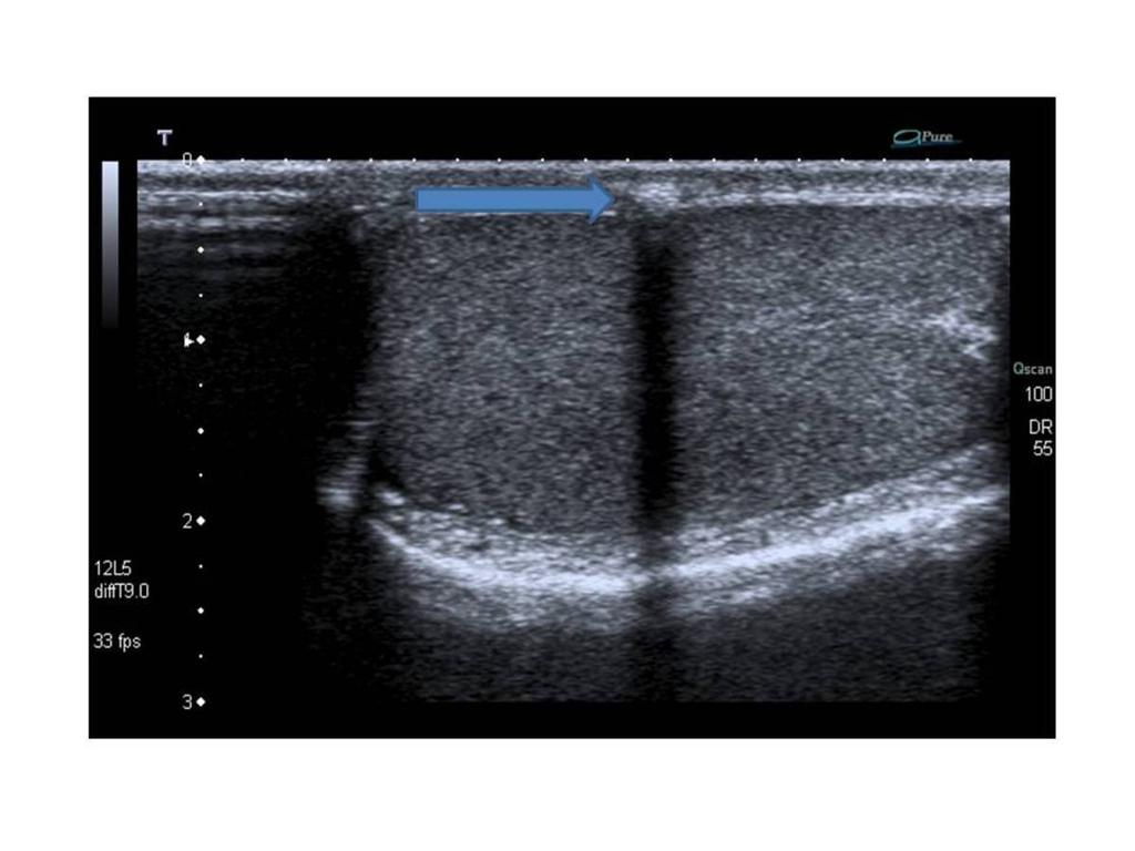 Fig. 21: Torsión de apéndice testicular. Varón de 25 años que se nota bulto en testículo izquierdo. Refiere episodio de orquiepididimitis tratado hace un año aproximadamente.