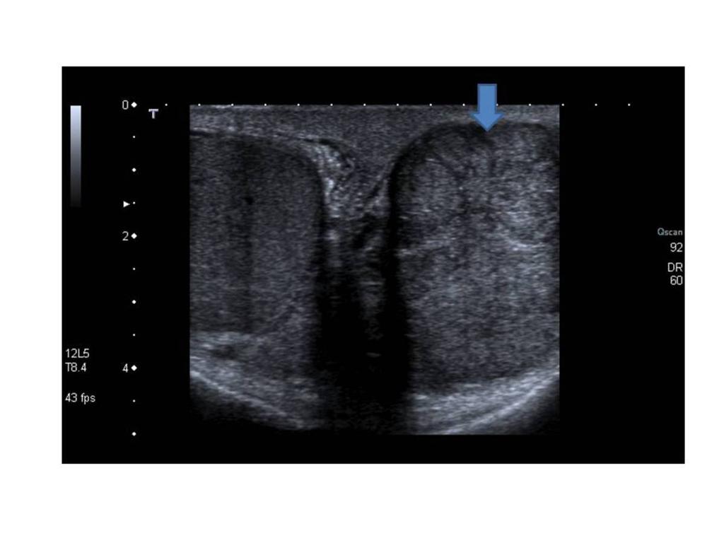 Fig. 30: Tumor testicular. Varón de 35 años con aumento de tamaño del hemiescroto izquierdo desde hace 6 meses.