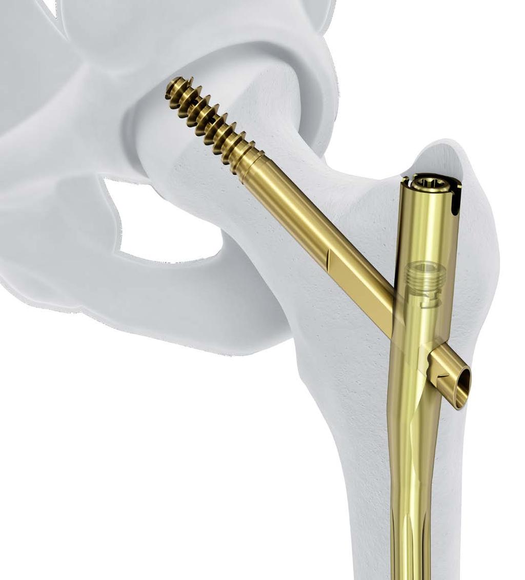 Para fijación intramedular de fracturas del fémur proximal Instrumental e implantes aprobados por la AO Foundation.