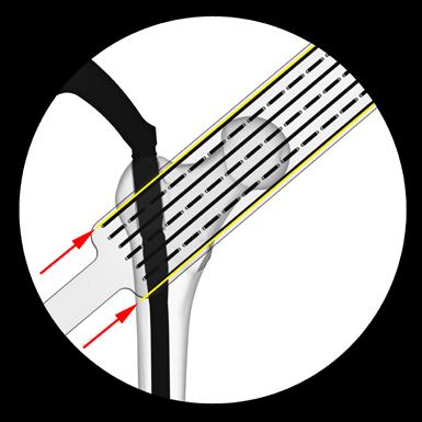 Opcional: puede montar también la pieza de separación entre el brazo direccional y la guía para aguja guía, y obtener así otros 10 cm
