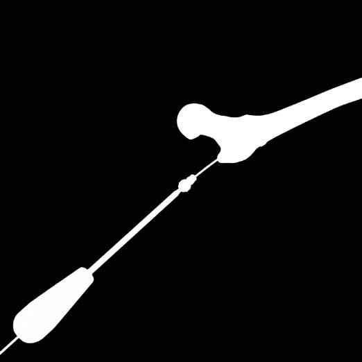 Se puede utilizar una aguja guía para ayudar a garantizar la alineación durante la inserción del tornillo de cierre. Una vez insertado el tornillo de cierre, desmonte el arco de inserción del clavo.