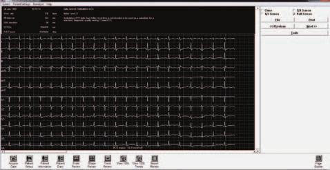 Además, el algoritmo HRV combinado con Turbulencia de la FC proporciona una vista más completa del sistema autónomo del paciente.