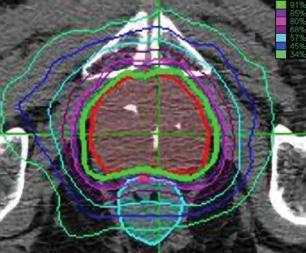 C O L I M A D O R D E A P E R T U R A V A R I A B L E I R I S Comparación de tratamiento de tumor prostático con el Sistema CyberKnife 35 Gy administrados en 5 fracciones Tratamiento con colimador