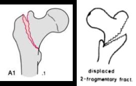 cervico-cefálico no permanece conectado a los trocánteres o aquellas en las que la extensión cortical inferior no es suficientemente amplia para dificultar su movimiento rotacional (65).
