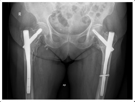 Figura 13. Clavo endomedular bilateral: Gamma (1ª generación) en cadera derecha y PFNA (3ª generación) en cadera izquierda. 1.5.2.2. Sustitución protésica en las fracturas extracapsulares.