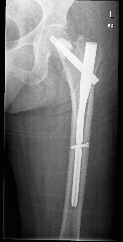 Figura 16. PFNA-Augmentación en una fractura de cadera.