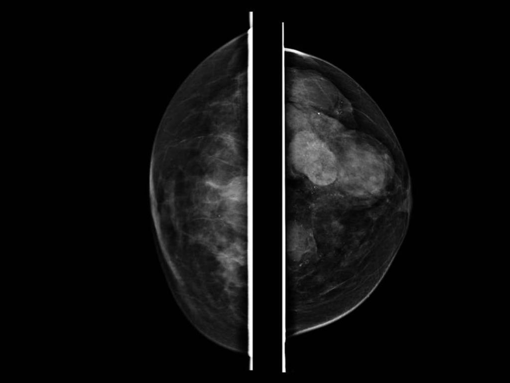 Fig. 10: Pryección craneocaudal de ambas mamas.