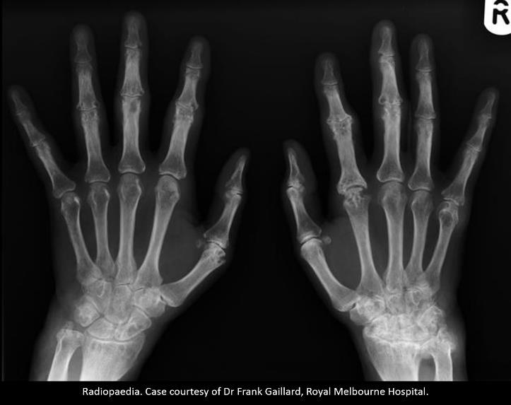 D) Artritis reumatoide: erosiones marginales no proliferativas, osteopenia yuxtaarticular. (De Zhang et al.). http://zl.elsevier.