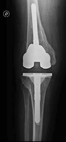 En tres pacientes con pérdida de stock óseo, se usaron cuñas metálicas para corregir el defecto. Se utilizó aloinjerto para reconstruir el aparato extensor de un paciente.