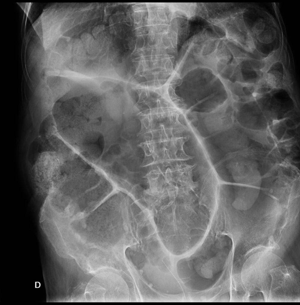 -2. Signo de grano de café Signo diagnóstico de vólvulo en colon sigmoide. Recuerda que el vólvulo no es más que una obstrucción causada por torsión de un asa intestinal sobre su eje mesentérico.
