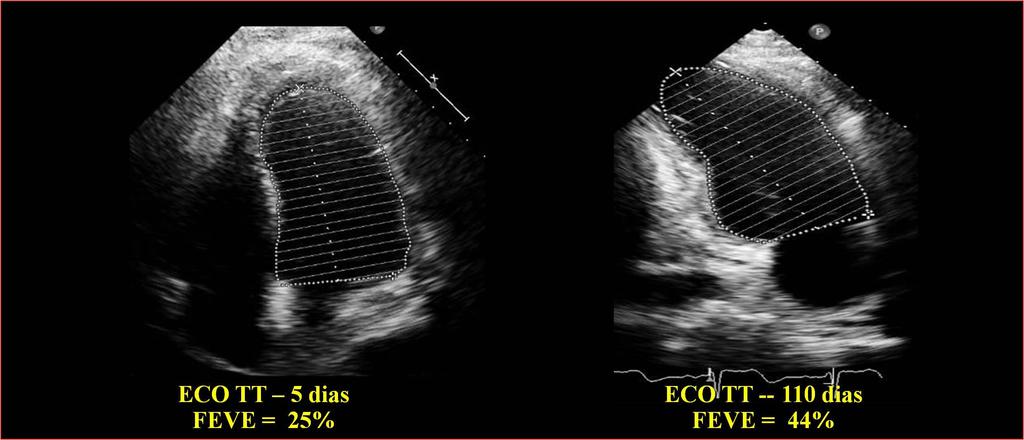 Ecocardiograma ELC -