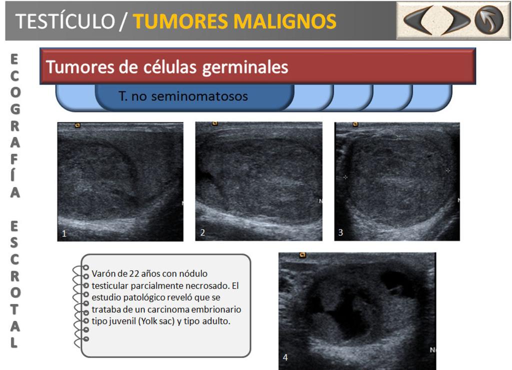 Fig. 15: Diapositiva que muestra un ejemplo de tumor no seminomatoso.