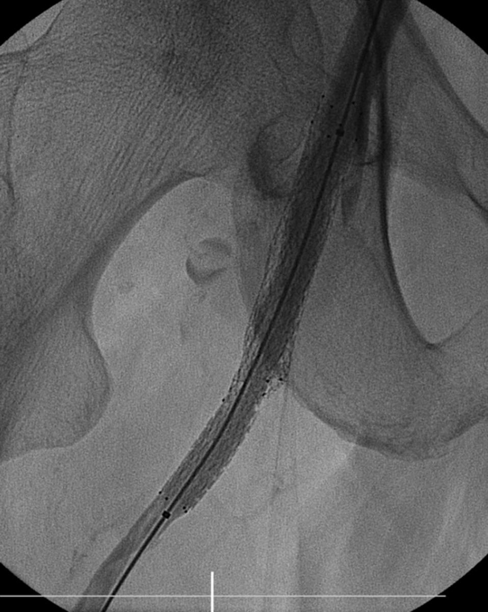 Fig. 32: Colocación de stent