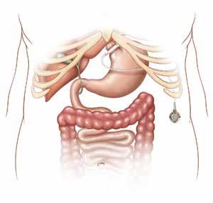 El procedimiento Bolsa estomacal pequeña. La banda gástrica se coloca alrededor de la parte más alta del estómago para crear una bolsa pequeña superior y un estómago inferior.