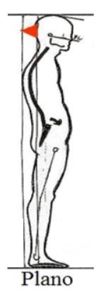El pie plano se caracteriza por carecer de arco longitudinal medial lo que influye de forma negativa a nivel reflejo sobre todo en la columna vertebral.