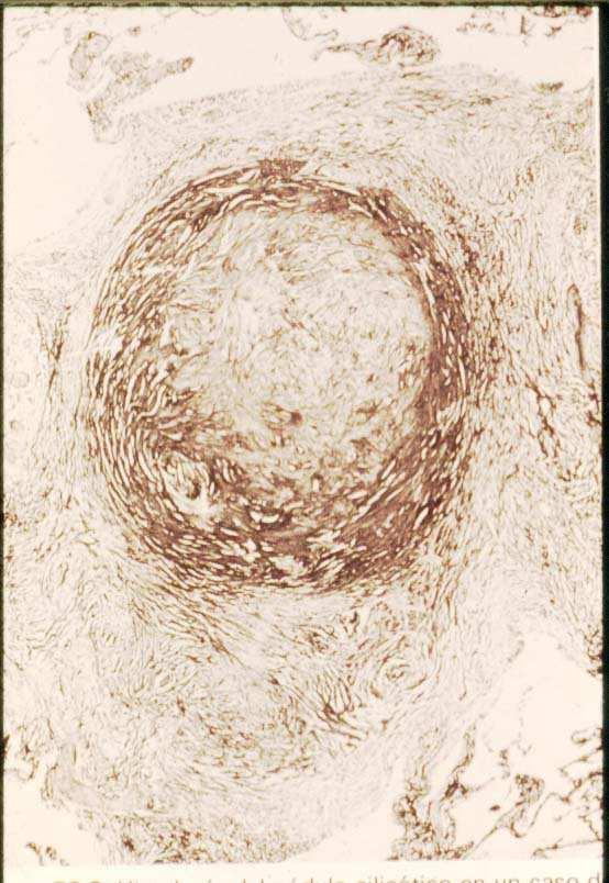 Silicosis La forma crónica es la más habitual, se desarrolla tras 10-20 años de exposición a niveles relativamente bajos de polvo Rx de tórax caracterizada por la presencia de un patrón micronodular
