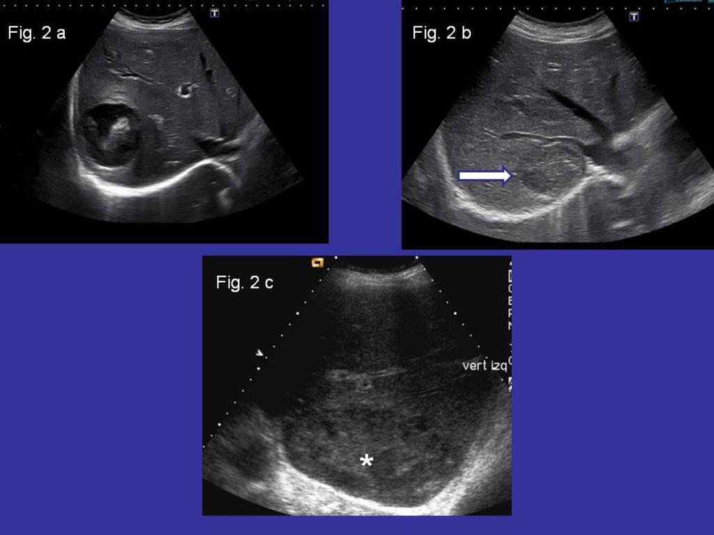 Fig. 2: Ecogenicidad basal de las lesiones. La imagen 2a muestra una lesión hipoecoica.