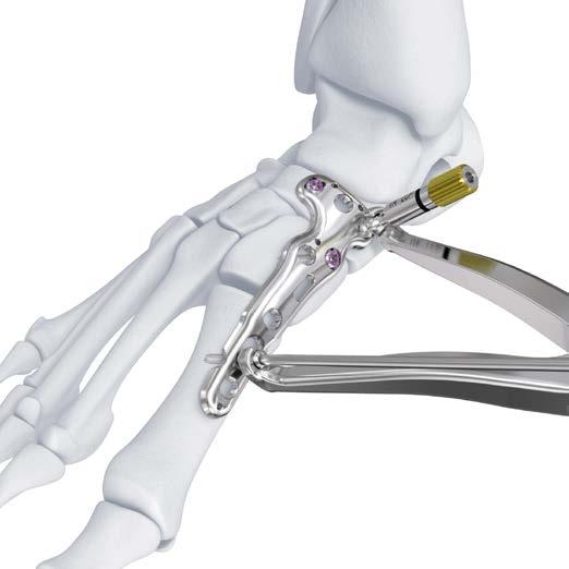Inserte la aguja tan distal como lo permita la anatomía, con el fin de obtener la máxima compresión. Consulte la técnica específica en el apartado A2.