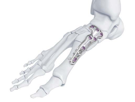 artritis importantes de la columna medial, formado por el primer metatarsiano, la primera cuña,