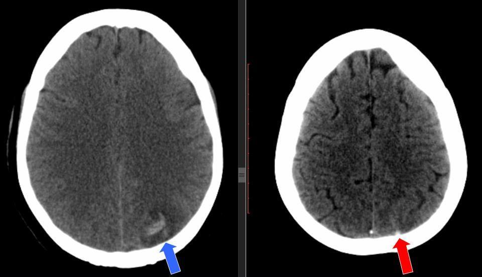 Figura 3. Mujer de 49 años, con hipertensión arterial, que debutó con crisis comicial. Una pequeña hemorragia cortical parietal izquierda (flecha azul) es evidente en la TC sin contraste.