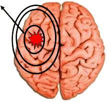 FOCO EPILÉPTICO Y ÁREA DE PROPAGACIÓN Foco epiléptico: área cerebral que actúa como la principal fuente de descargas