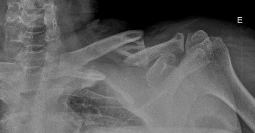 Tratamiento quirúrgico de las fracturas diafisarias y conminutas de la clavícula 129 Figura 1 Fractura conminuta diafisaria de clavícula.