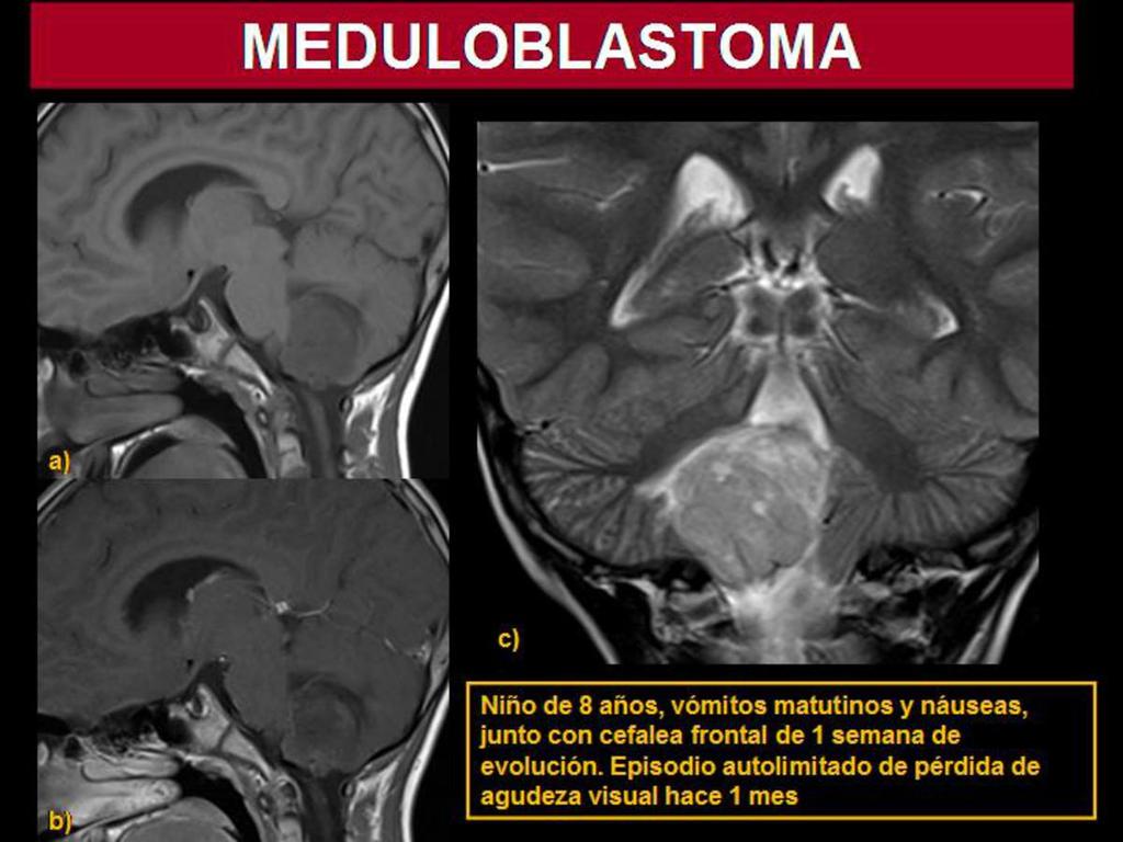 Fig. 4: Meduloblastoma en niño de 8 años que presentaba síntomas de hipertensión intracraneal.