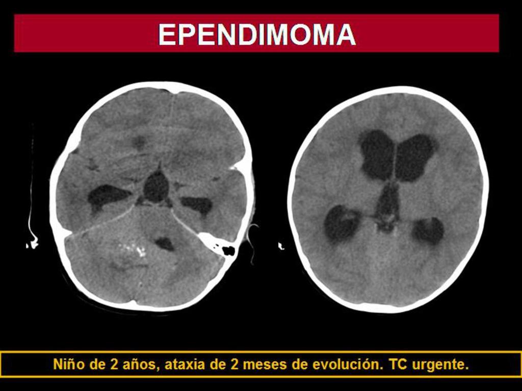 Fig. 14: Ependimoma en niño de 2 años con ataxia de 2 meses de evolución.