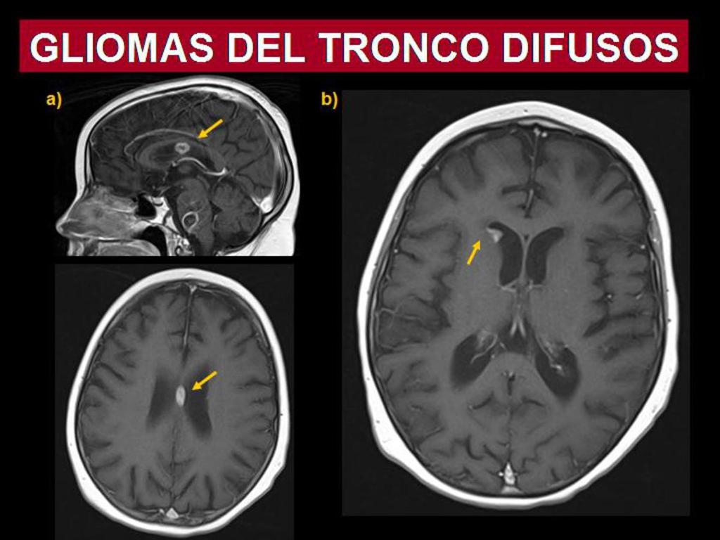 Fig. 19: Niña de 8 años con glioma difuso del tronco. Además en el estudio tambien se observan dos imágenes nodulares, de localización intraventricular subependimaria, de nueva aparición.
