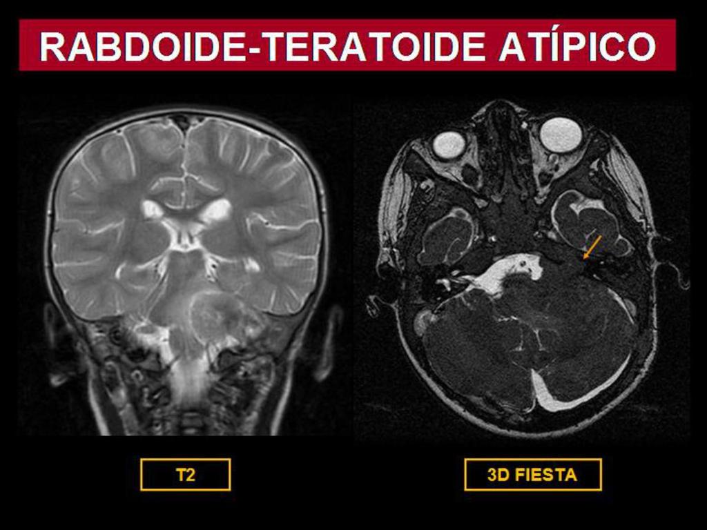 Fig. 22: Niño de 15 meses con tumor rabdoide-teratoide atípico en fosa posterior.