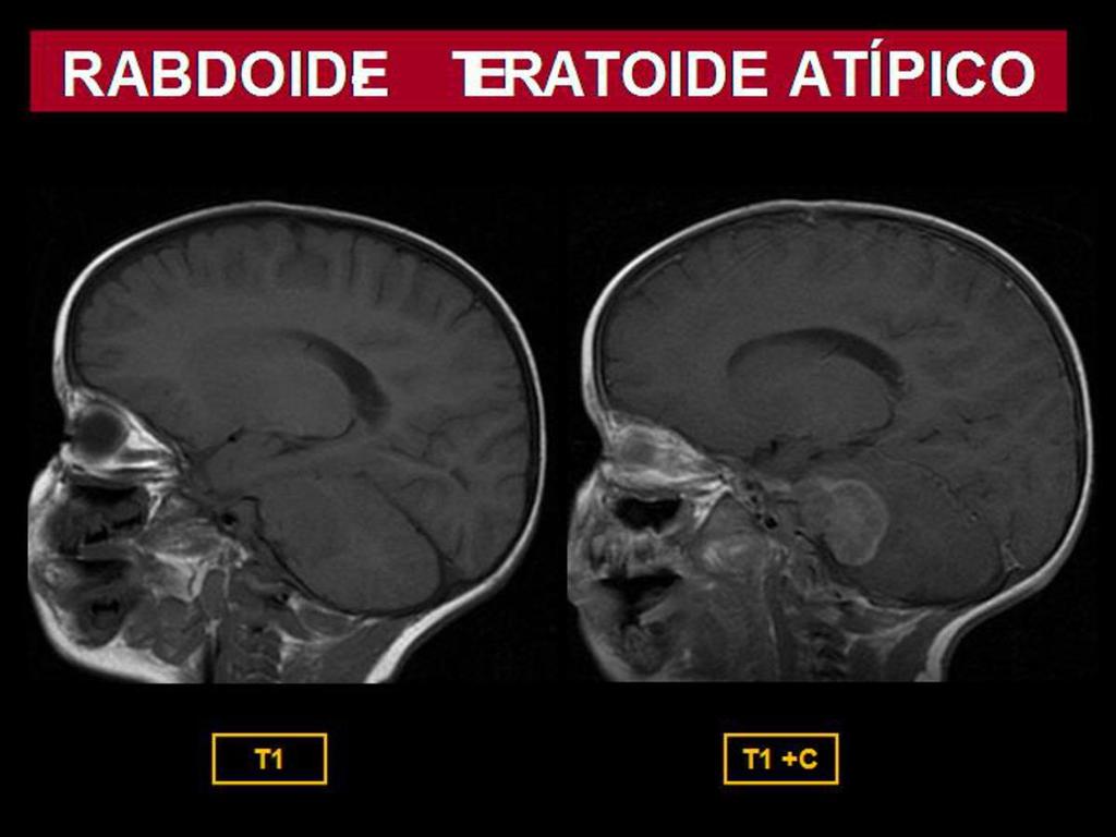 Fig. 23: Niño de 15 meses con tumor rabdoide-teratoide atípico en fosa posterior.