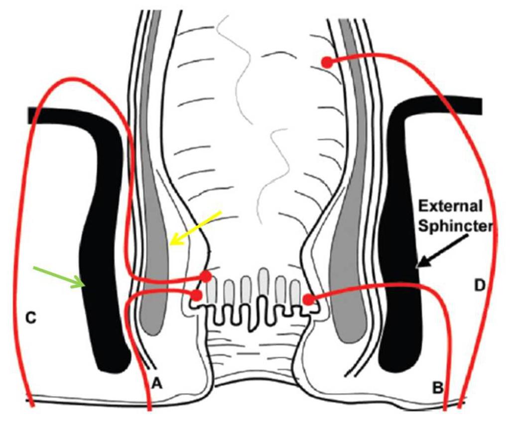 En la enfermedad transelevatoria el trayecto fistuloso se extiende directamente desde su origen en pelvis a la piel perineal a través de las fosas isquiorrectal e isquioanal sin participación del