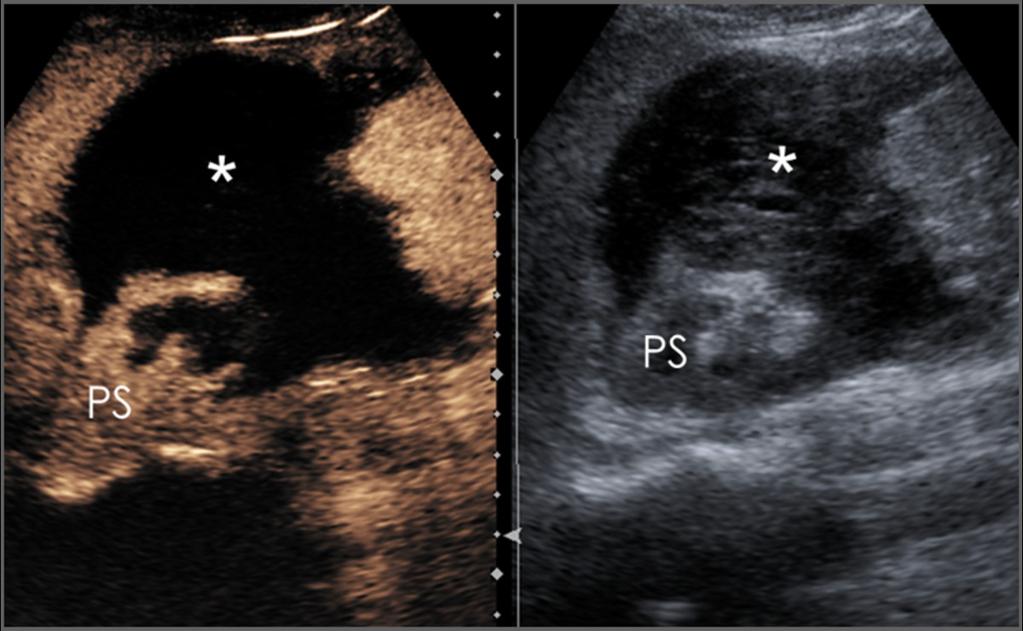 Fig. 14: Paciente anterior ecografía basal y con contraste.