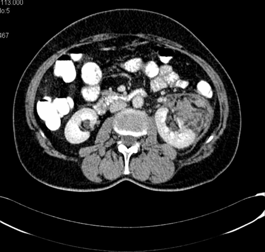 Fig. 19: Paciente con traumatismo renal leve e intenso dolor en fosa renal izquierda. En TC de observa la presencia de lesion heterodensa que alterna zonas hiperdensas con zonas con densidad grasa.