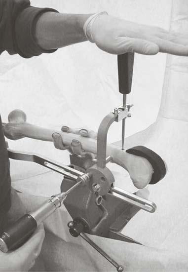 Ejercer una presión continua en el mango del gancho indicador (14) asegura el contacto con el clavo durante las siguientes operaciones. Empuje la vaina de protección hística 11.0/8.0 (355.