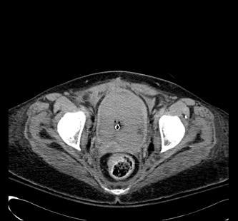 Caso nº 2: Paciente con antecedentes de carcinoma de endometrio tratado con radioterapia. Actualmente con sospecha de sangrado activo a nivel vesical.