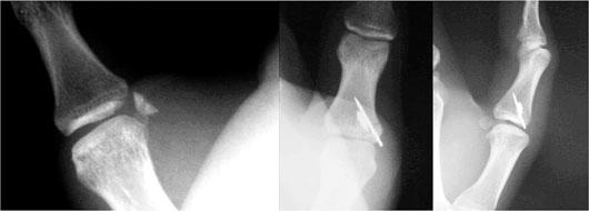R. Cancelo Barea Figura 7: Fractura base F1 pulgar. Osteosíntesis. preciso de la lesión y se practique una rehabilitación adecuada.