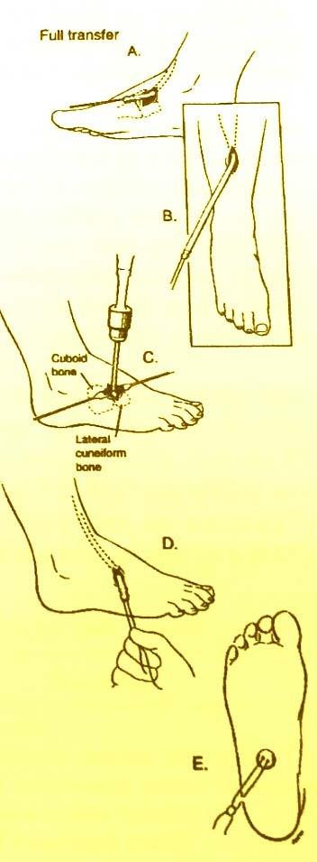46 Imagen 1: Técnica de transferencia Tendinosa del Tibial Anterior a Tercera Cuña en pacientes con de Pie Equino varo Hipocorregido 3.8.