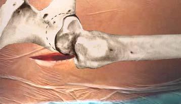 Cadera y rodilla contralaterales deberán flexionarse a 90 (para no dificultar el uso del amplificador de imágenes) y el tronco del paciente